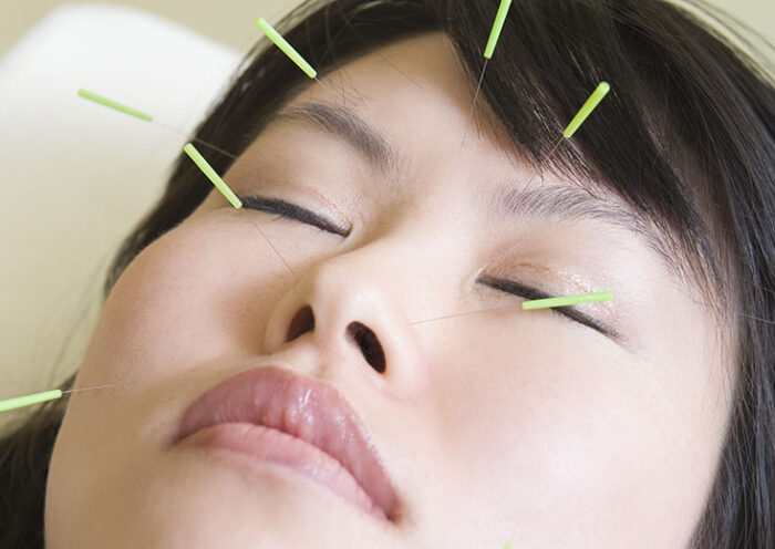 Asian woman with acupuncture needles in her face