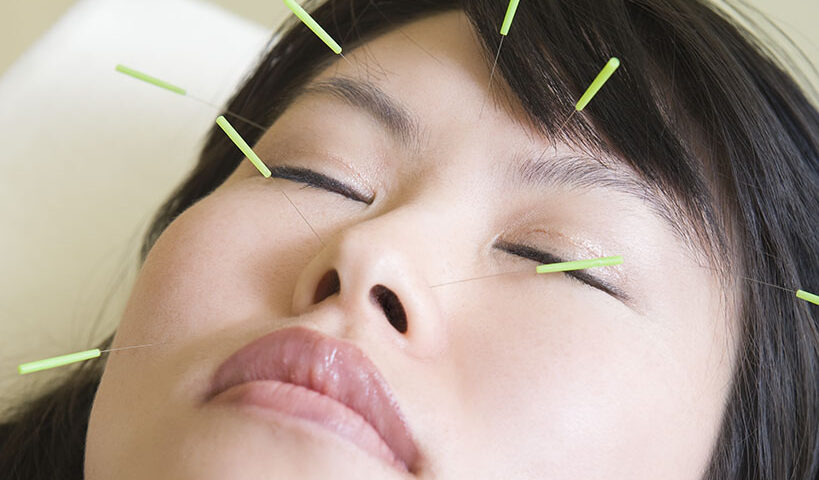 Asian woman with acupuncture needles in her face
